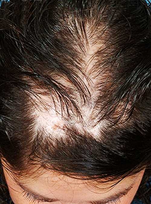 Почему выпадают волосы от нервов и как это остановить + методы лечения
