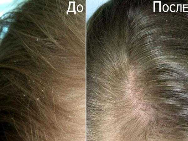 Дегтярный шампунь для роста волос