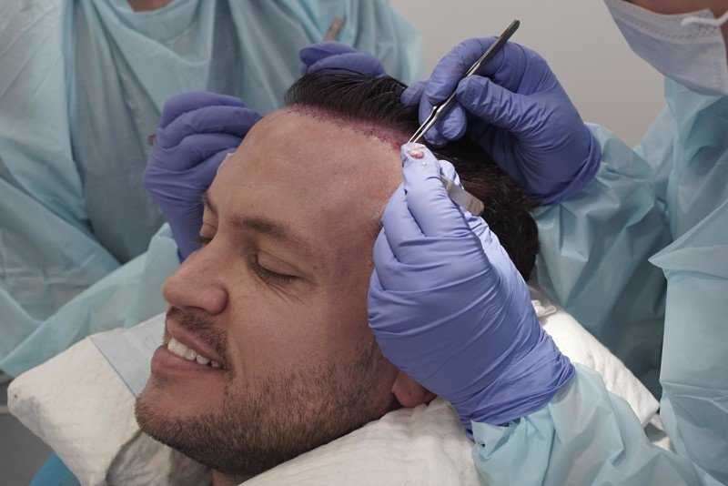 Что такое донорская зона при трансплантации волос?