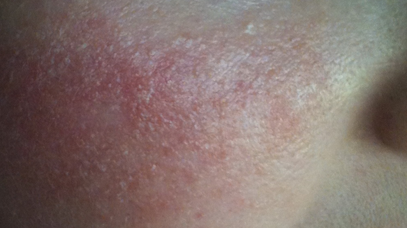 Сыпь на спине – что может быть причиной, и можно ли от нее избавиться?