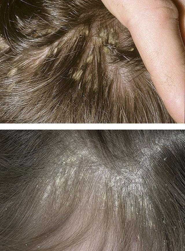 Лечение себорейного дерматита волосистой части головы