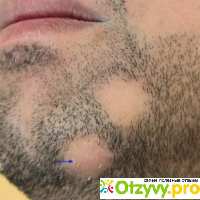 Особенности и симптомы алопеции на бороде у мужчин. причины появления проплешин на подбородке. лечение облысения бороды: аптечные средства, народные способы. профилактика.