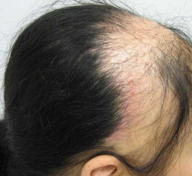 10 причин выпадения волос