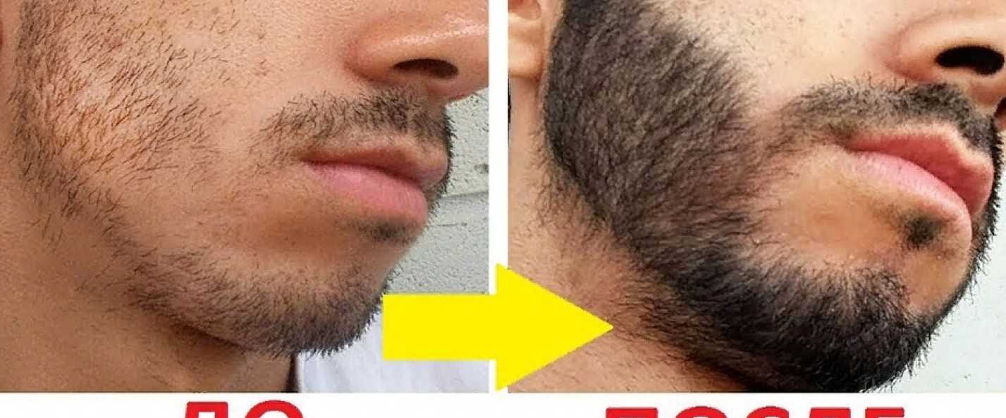 Как сделать, чтобы борода росла быстрее: советы для ускорения появления волос на лице