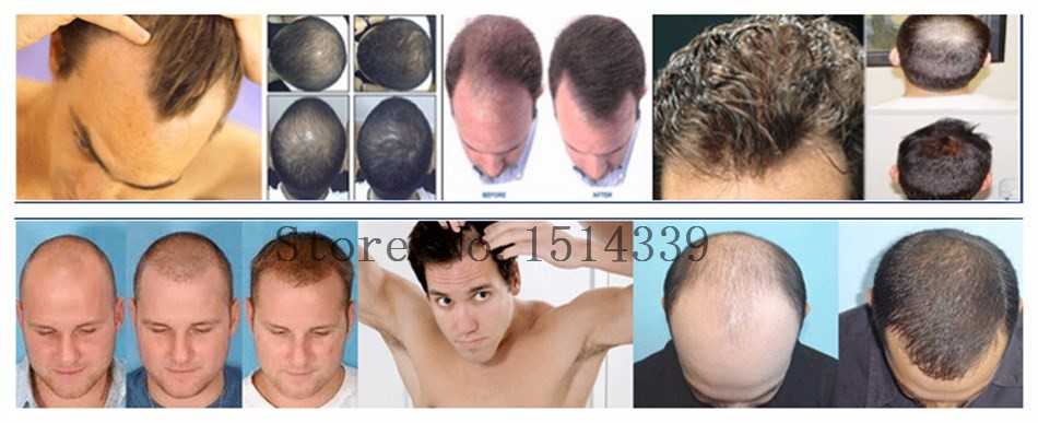 Генеролон для роста волос: состав спрея и как применять, побочные эффекты, отзывы о использовании