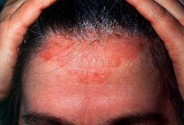 Себорейный дерматит волосистой части головы: лечение и причины