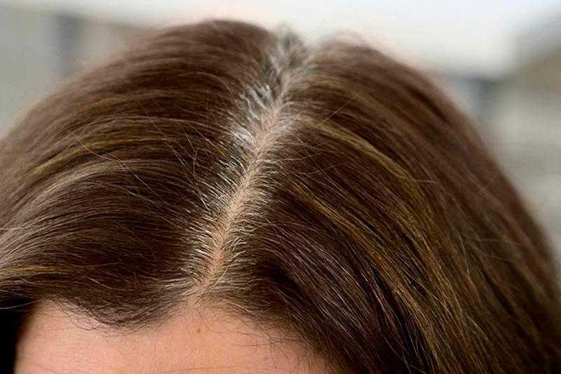 Почему седеют волосы – причины у женщин и мужчин, как с этим бороться