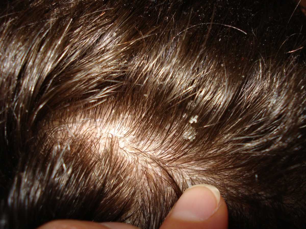 Различие признаков себорейного дерматита на коже головы и лица