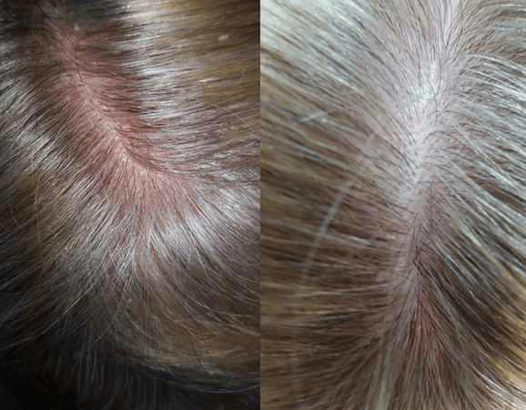 Почему возникают красные и коричневые пятна на голове? распространенные причины