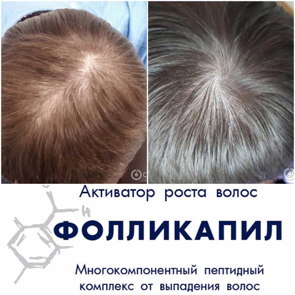 Активатор роста волос фолликапил: биологически активный комплекс