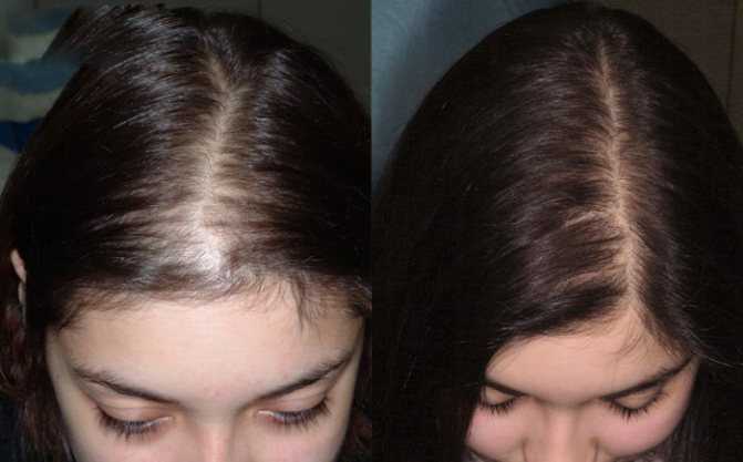 Как укрепить волосы от выпадения? профилактика и лечение