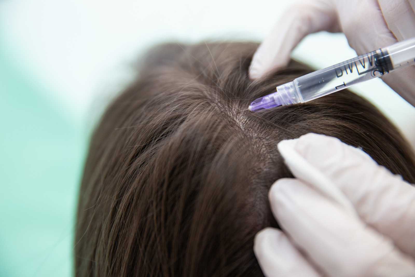 Мезотерапия для волос в москве