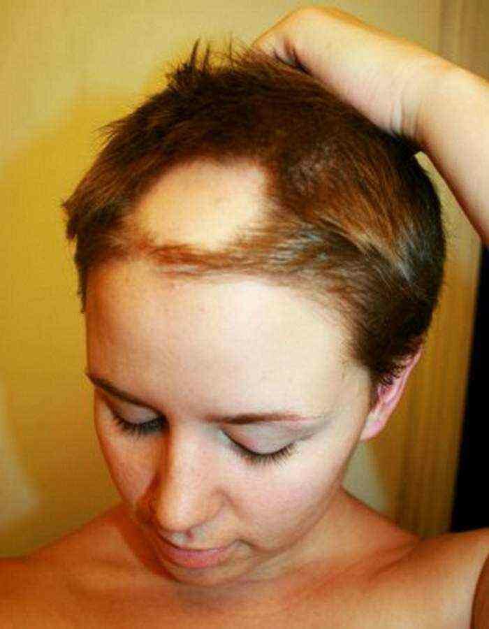 Выпадение волос у женщин: причины и лечение в домашних условиях, средства от выпадения волос для девушек