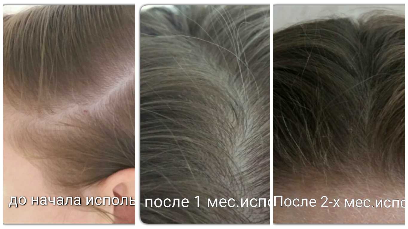 Как вернуть густоту волосам после выпадения или облысения: можно ли восстановить былую шевелюру, смогут ли они снова вырасти