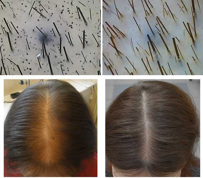 Никотиновая кислота для волос: как использовать? развенчиваем мифы