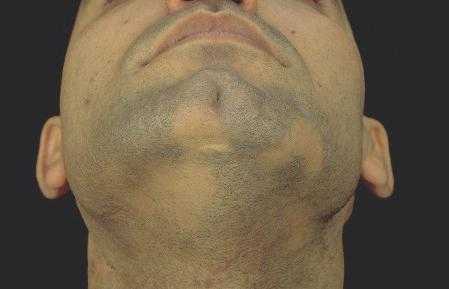 Плешь на бороде: почему появляется алопеция у мужчин и чем лечить проплешину