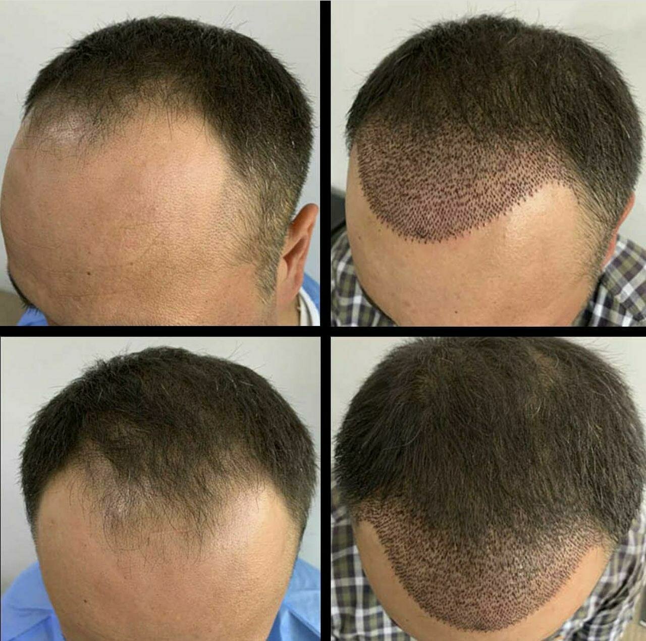 Пересадка (трансплантация) волос на голове. операция по пересадке волос: противопоказания, реабилитация, послеоперационный период