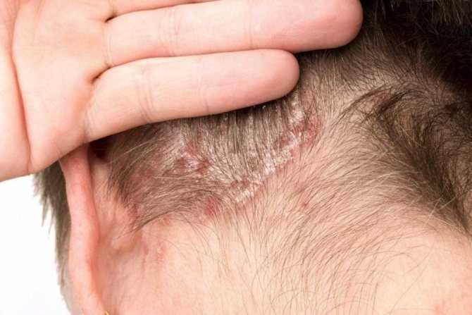 Основные причины появления, первая помощь и лечение красных пятен на коже головы