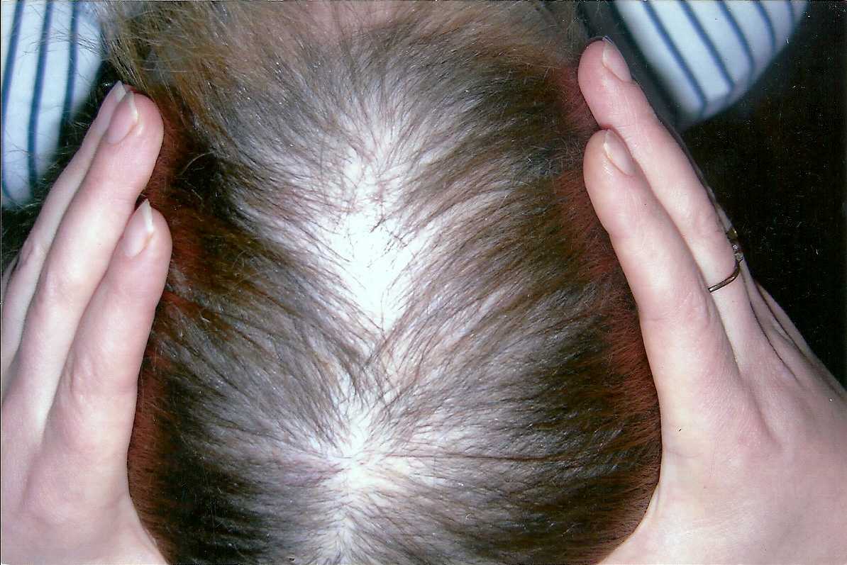 Почему выпадают волосы от нервов и как это остановить + методы лечения