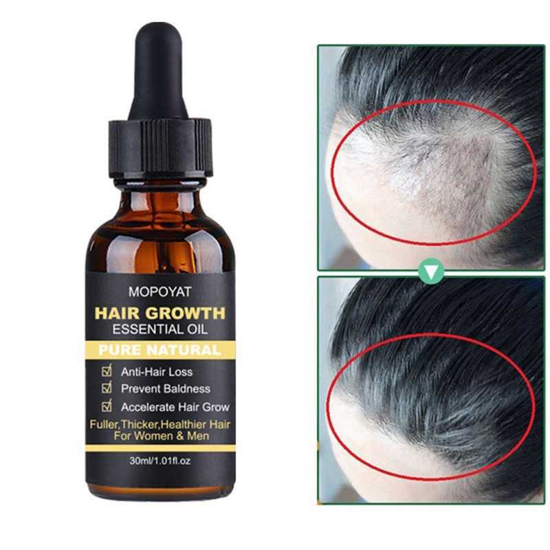 Способы применения касторового масла от выпадения волос, топ-5 масок от облысения