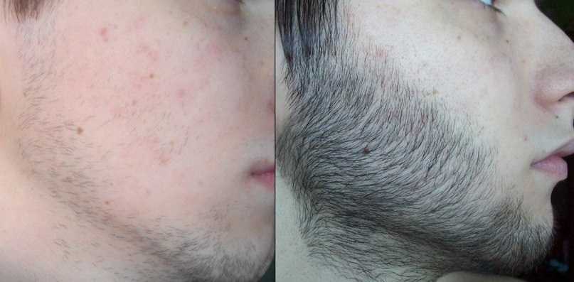 Почему появляются проплешины на бороде? самые эффективные методы лечения алопеции у мужчин