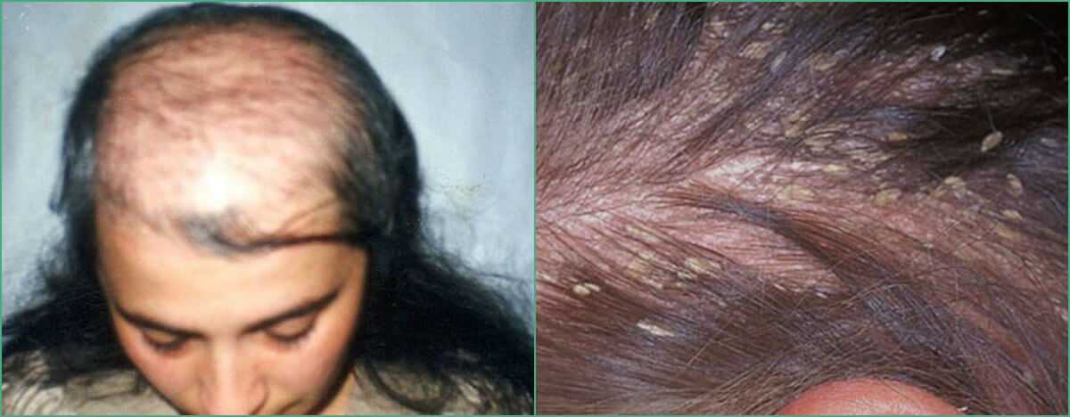 Какие бывают лекарства от выпадения волос