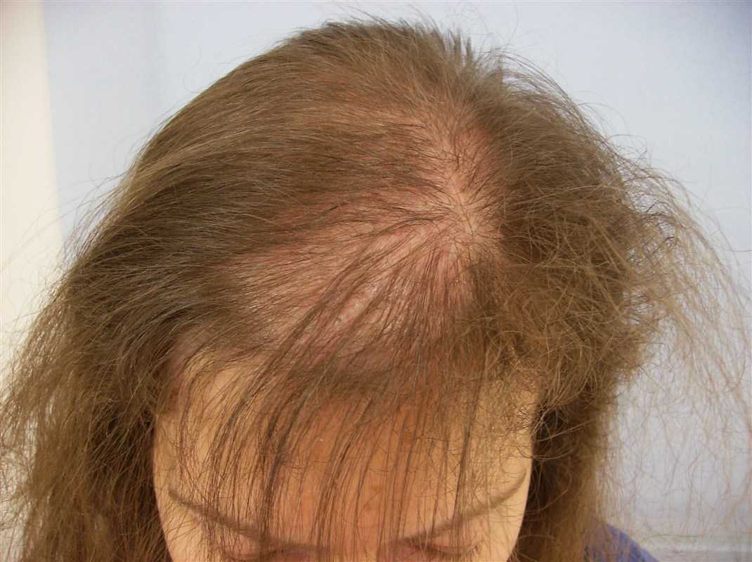 Что делать если сильно выпадают волосы на голове