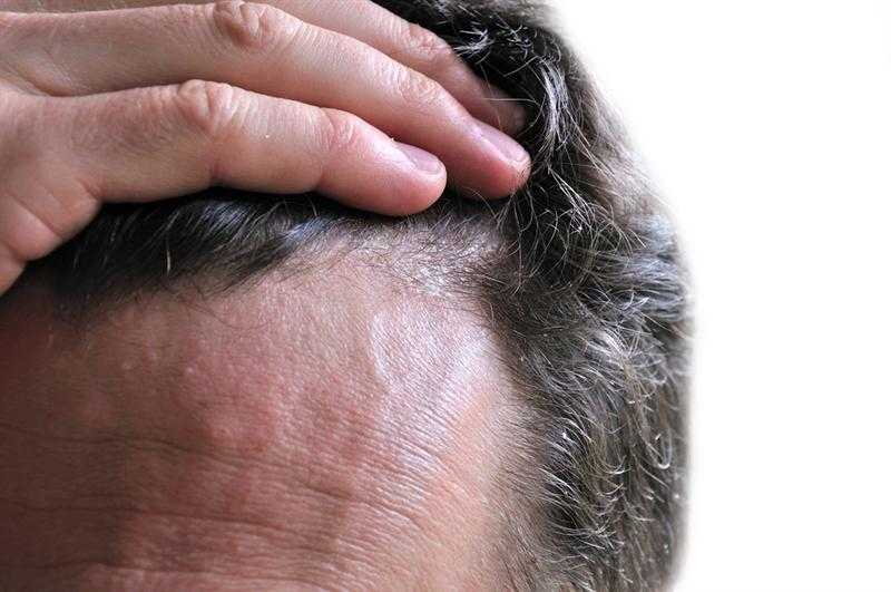 Основные причины появления, первая помощь и лечение красных пятен на коже головы