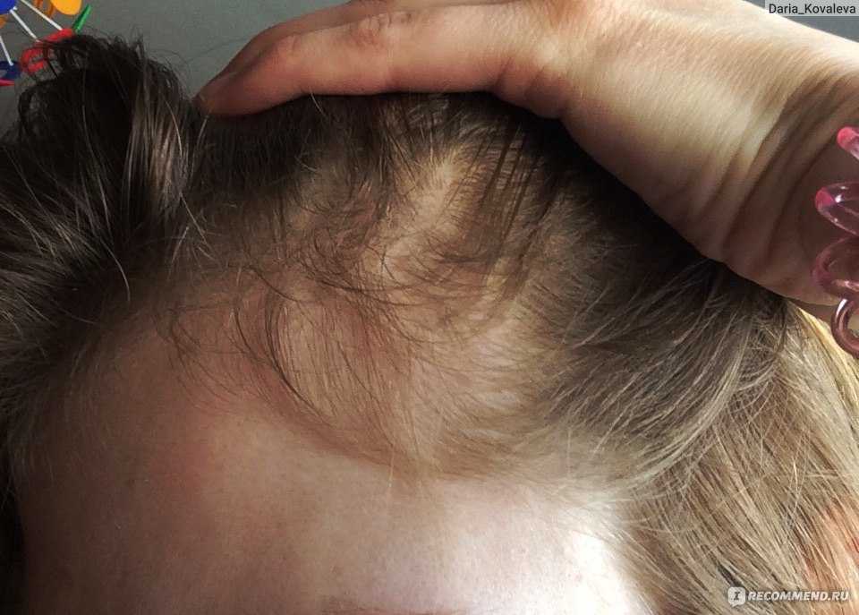 Можно ли восстановить волосы после облысения: популярные методы и средства для мужчин и женщин