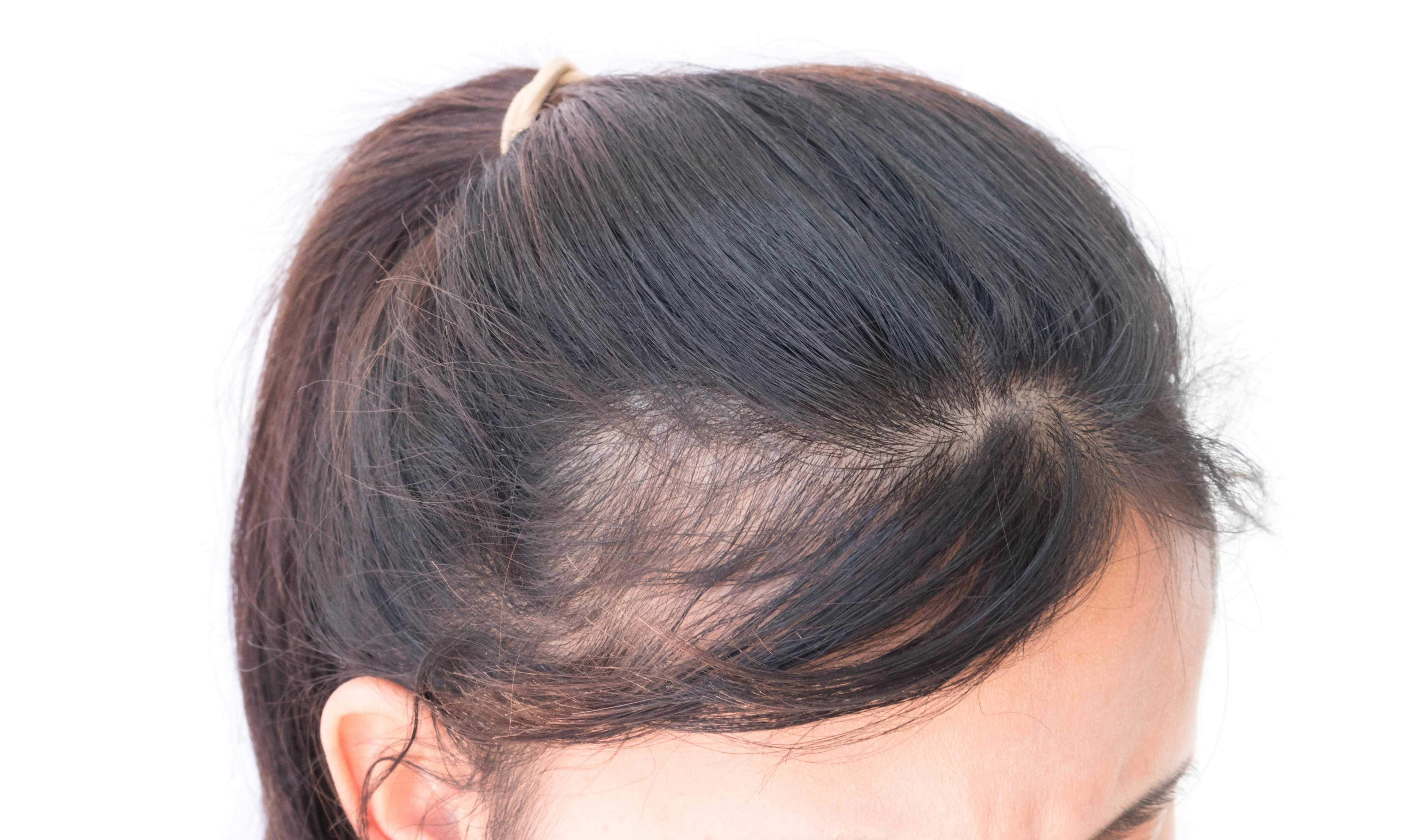 При какой химии гарантирована потеря волос, а какие препараты химиотерапии практически не вызывают выпадение волос