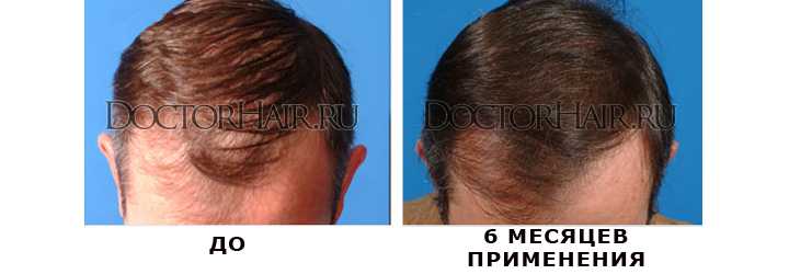 Миноксидил – безусловный активатор роста волос