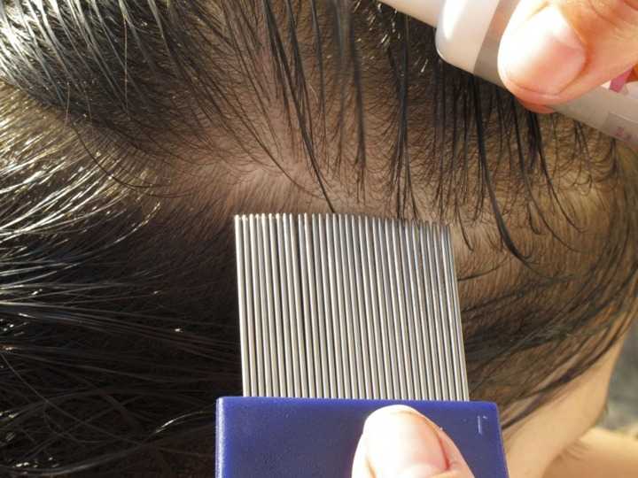 Чем и как вычесать гнид в домашних условиях после обработки волос?