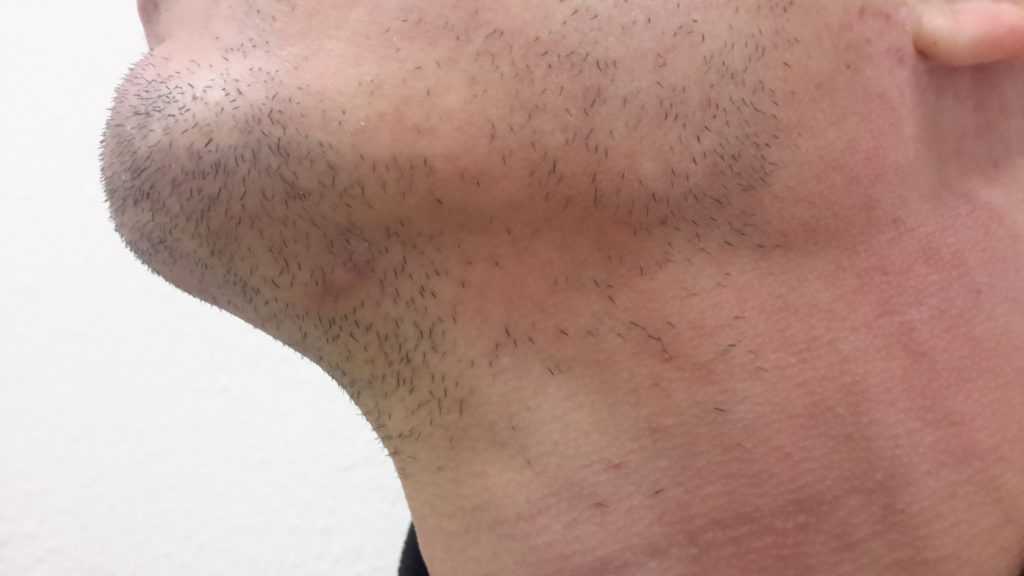 Причины и способы лечения алопеции бороды у мужчин
