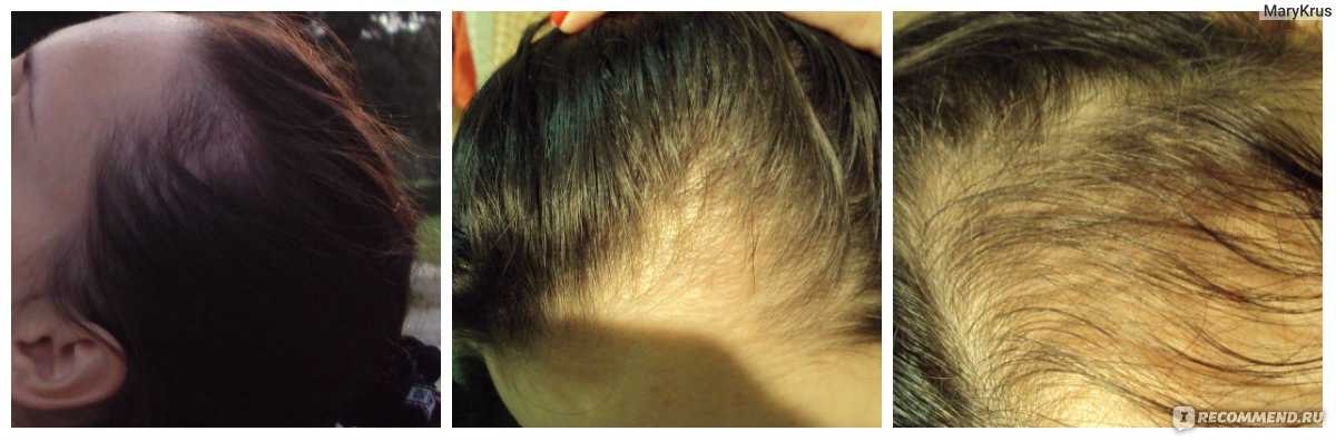 Выпадают волосы после родов — основные причины, советы как остановить и что делать, если начали выпадать волосы