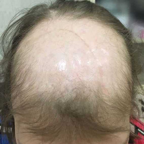 Как избежать выпадения волос при химиотерапии
