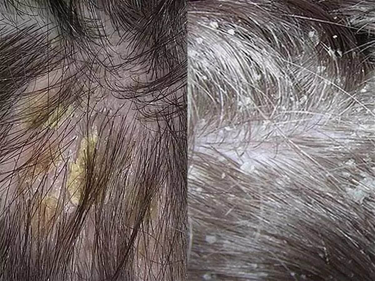 Себорейный дерматит волосистой части головы у ребенка 11 лет лечение