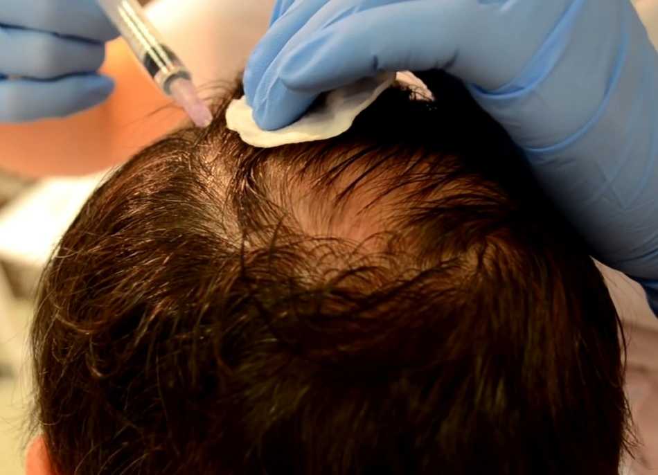 Риски проведения мезотерапии для восстановления волос