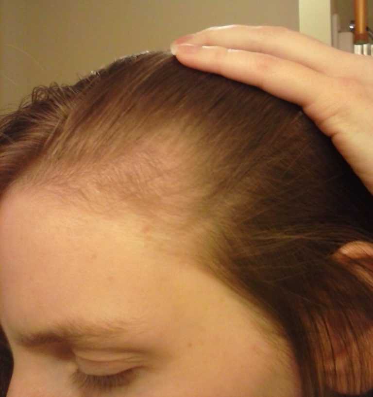Выпадение волос при бусерелине