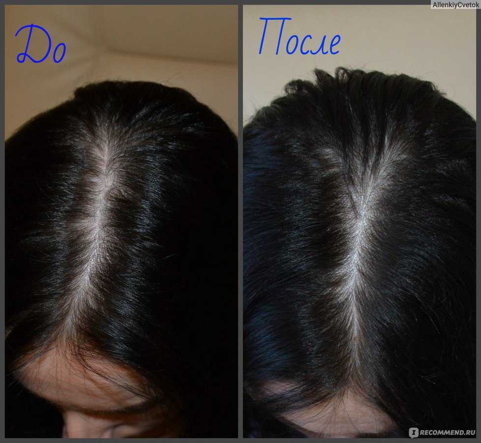 Никотиновая кислота для волос: польза, рецепты, результаты