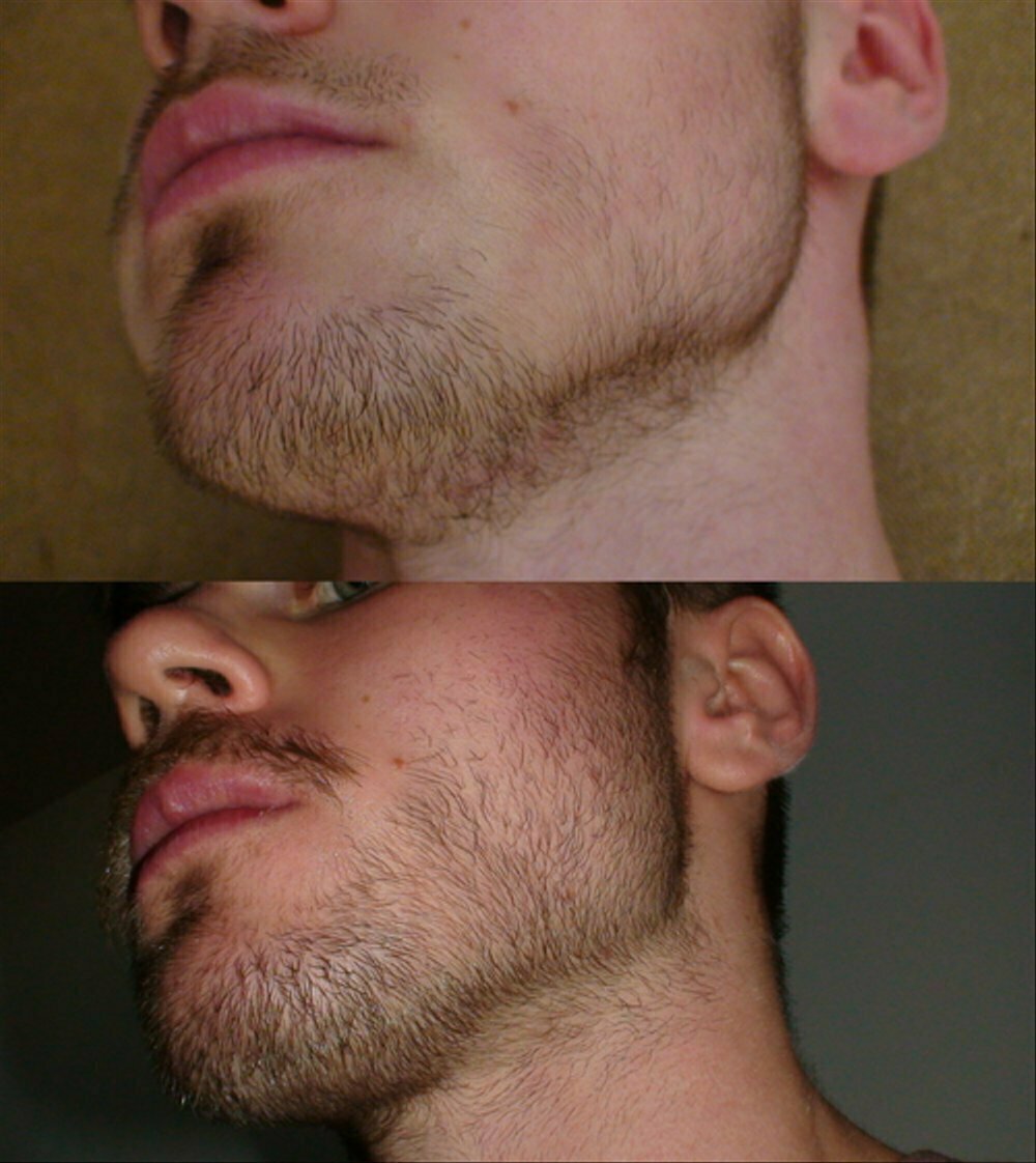 Самые эффективные мази для роста бороды: помогают ли они?