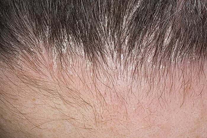 Дерматоз: симптомы и лечение, фото атопического дерматита волосистой части головы, течение болезни у взрослого и ребенка