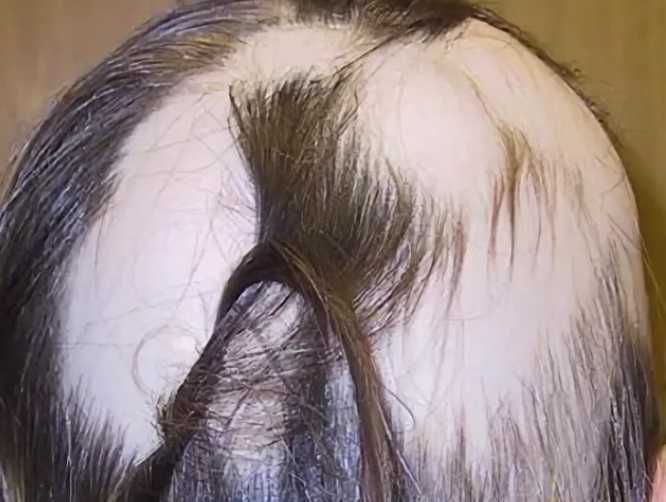После окрашивания выпадают волосы: что делать?