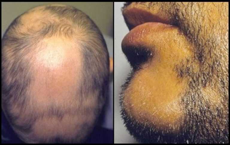 Алопеция на бороде у мужчин причины возникновения и методы лечения