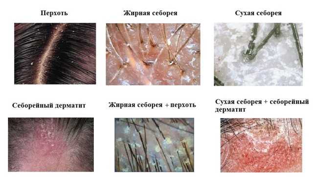 Сухая себорея кожи головы: лечение в домашних условиях, шампуни, другие .