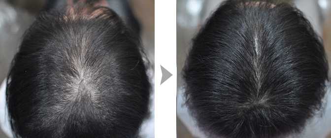 Выпадение волос после родов – причины и лечение