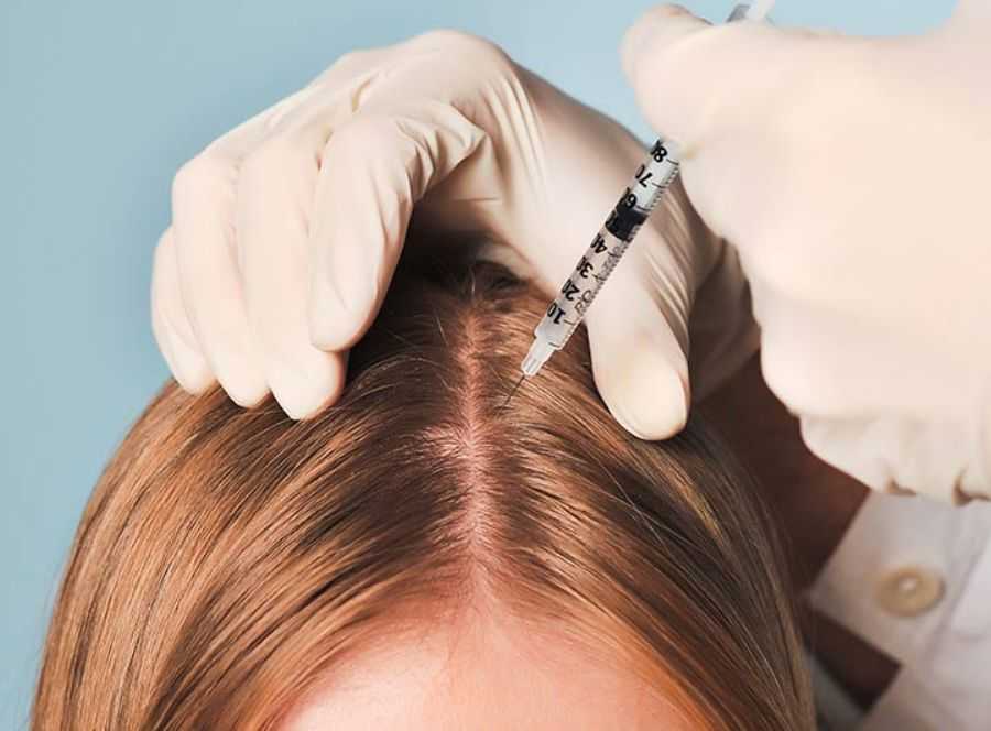 Что такое мезотерапия для волос и как она проводится?