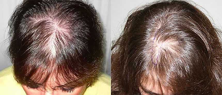 После краски палет выпадают волосы. что делать, если после окрашивания сильно выпадают волосы