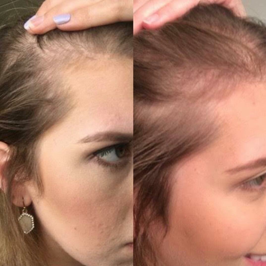 После покраски волосы выпадают что делать: как остановить различными средствами при сильной потере?